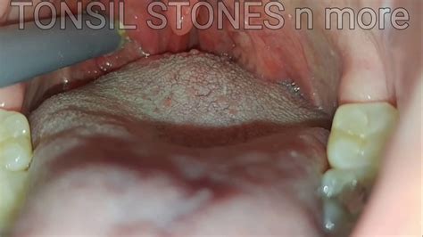 Tonsil Stones Youtube