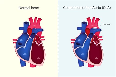 Coarctation Of The Aorta Pass The Nclex Rn With Illustrated Nursing