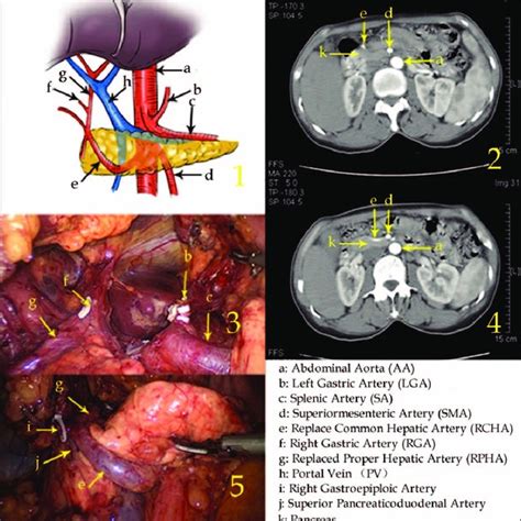 Type Vi The Replaced Left Hepatic Artery Arose From The Aberrant
