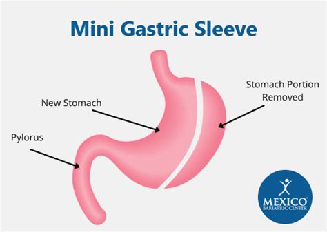 Mini Gastric Bypass Vs Mini Gastric Sleeve Mexico Bariatric Center