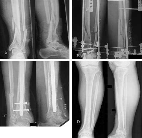 Two Ring Hybrid External Fixation Of Distal Tibial Fractures Journal Of Trauma And Acute