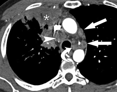 Patterns Of Lymphadenopathy In Thoracic Malignancies Radiographics