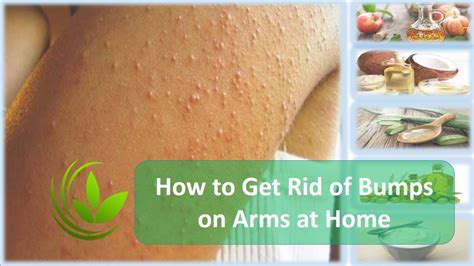 How To Get Rid Of Bumps On Arms At Home Youtube