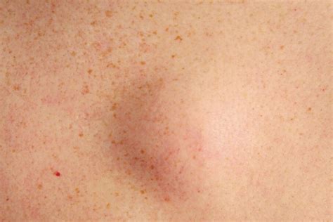 8 Fatty Deposits Lipoma 10 Grossest Things In Your Body Right Now