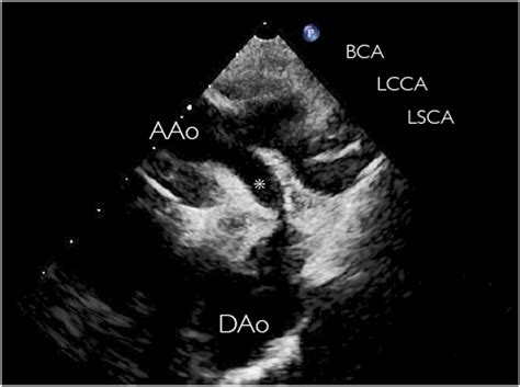Echocardiography Of Coarctation Of The Aorta Aortic Arch Hypoplasia