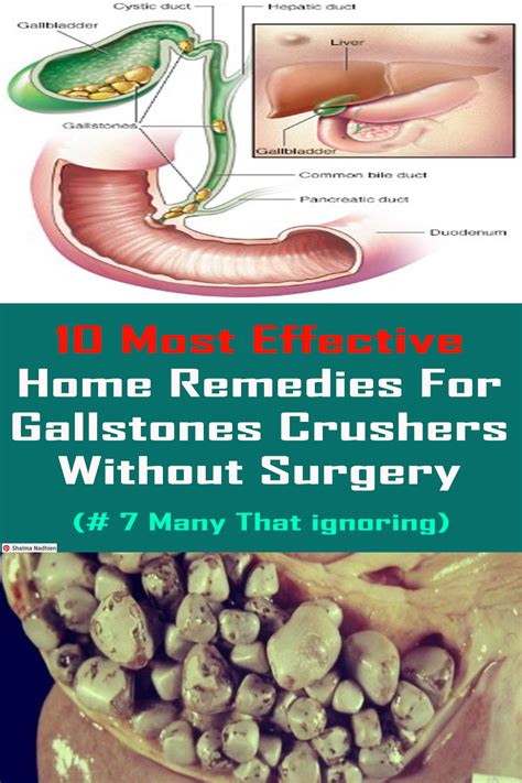 How To Destroy And Flush All Gallstones Naturally Without Any Surgery