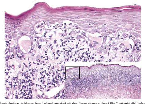 Figure 4 From Chronic Ulcerative Stomatitis Clinical Histopathologic