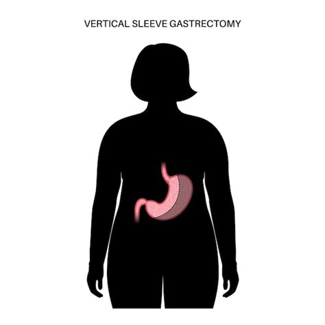 Premium Vector Vertical Sleeve Gastrectomy Laparoscopy Stomach