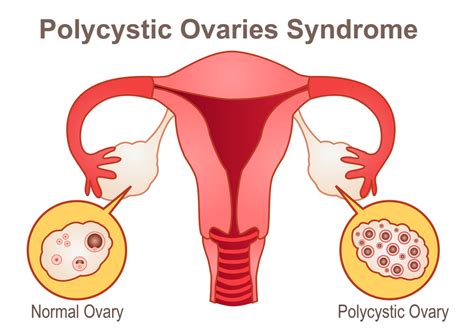 Pcos Poly Cystic Ovary Syndrome