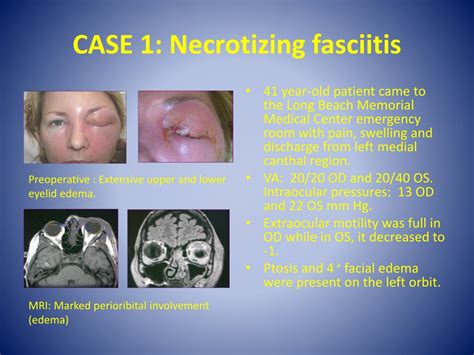 Ppt Treatment Of Periocular Necrotizing Fasciitis And Mucormycosis