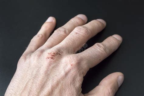 Chapped Hands From Cold Weather Dry Cracked Knuckles Stock Photo