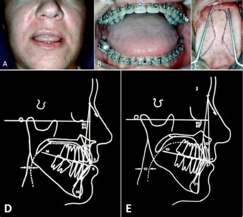 Macroglossia With Tongue Protrusion Larry M Wolford Dmd