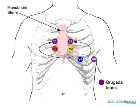 Pediatric Ekg 15 Lead Placement Diagram Wiring Diagram