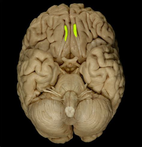 Cadaver Cranial Nerves Vasculature And Ventricles Neuroanatomy