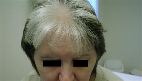 Derm Dx White Forelock Of The Frontal Scalp Clinical Advisor
