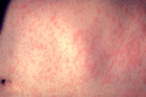 What You Should Know About Measles After A Case Confirmed In Mass