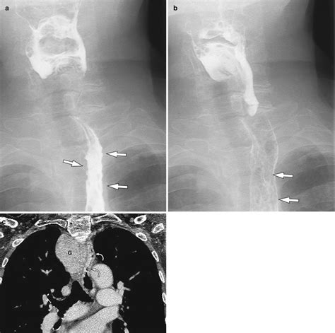 Benign Structural And Functional Abnormality Of The Esophagus