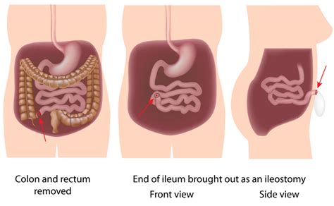 Ileostomy Ileostomy Information L United Ostomy Associations Of America