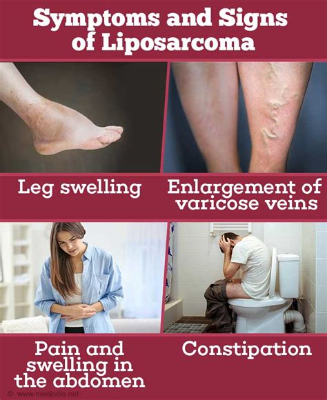 Liposarcoma Types Risk Factors Diagnosis And Management