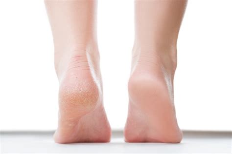 why are your feet peeling causes for peeling feet parade