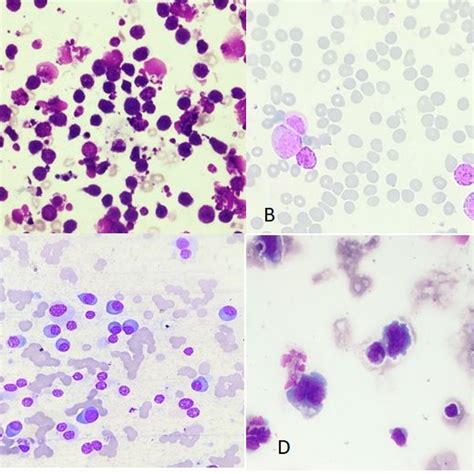 Spectrum Of Malignancies In Pleural Fluid Cytology Download