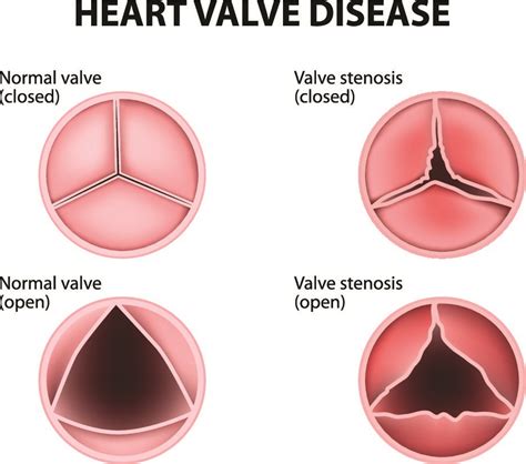 Valvular Heart Disease Symptoms And Treatment Pulse Cardiology