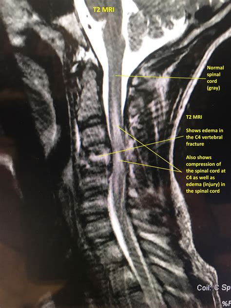 Spinal Cord Injury Matthew Lawson Md