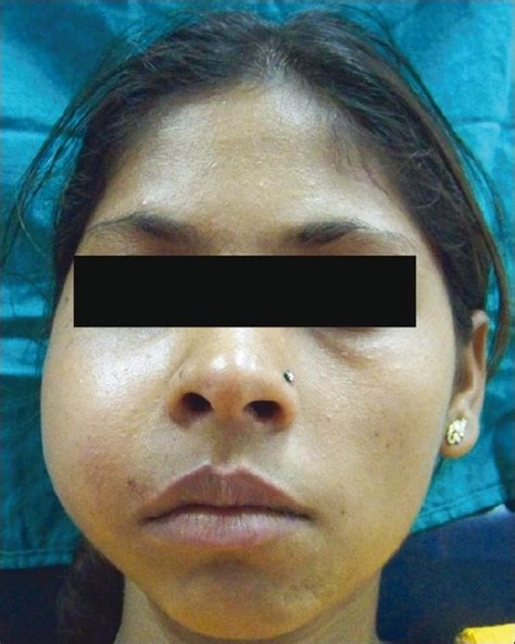 Facial Asymmetry Due To A Diffuse Swelling On The Right Side Of The