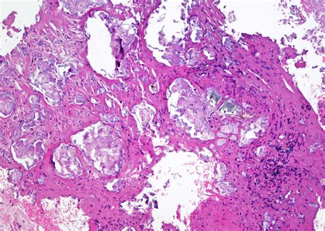 Pathology Outlines Eosinophilic Cystitis
