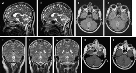 Preoperative Mri Scans Of A Patient With Rgnt A B T2 Weighted