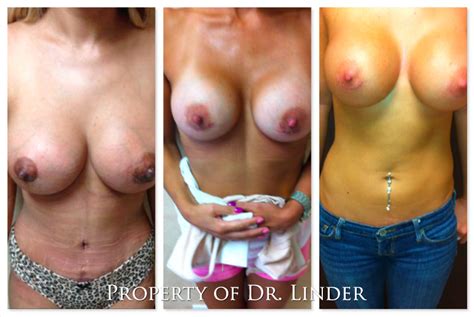 Latina Plastic Surgery Beverly Hills Dr Stuart A Linder