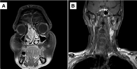 Magnetic Resonance Imaging Of The Primary Tumor And Lymph Node
