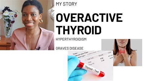 My Story Overactive Thyroid Hyperthyroidism Graves Disease Youtube