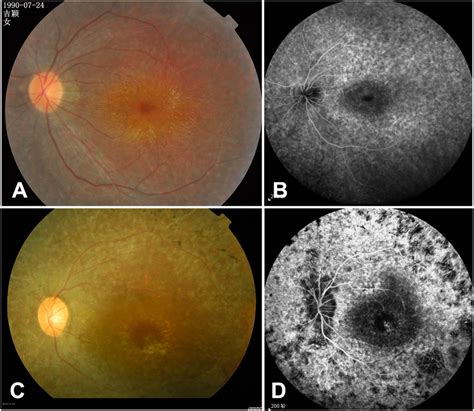Representative Fundus Photography And Fundus Fluorescein Angiography