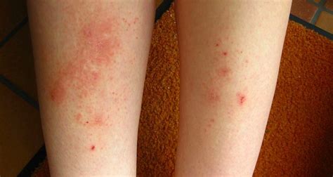 Here Are The 7 Most Common Types Of Eczema And How To Treat Each One
