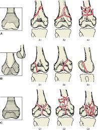Analyzed 92 patients from 1992 to 2009, with. distal femur fracture classification | Anthropology ...