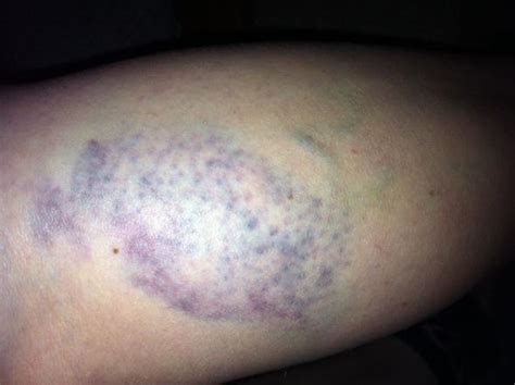 Was ist über mögliche nebenwirkungen bekannt? Harte Ader und danach blauer Fleck! (Gesundheit, Arzt, Adern)