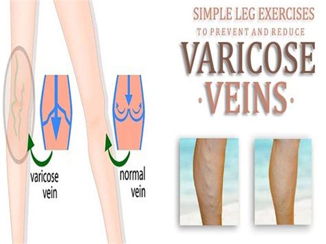 10 Best Exercises For Varicose Veins Treatment Styles At Life
