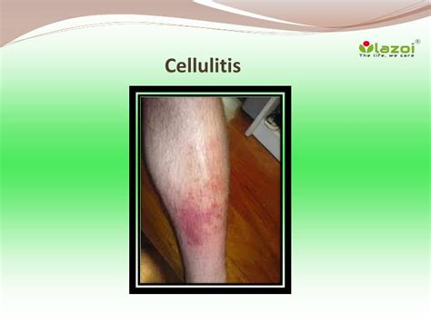 Early signs of cellulitis, a bacterial skin infection, include swelling and redness that come on quickly. PPT - Cellulitis: Symptoms, Causes, Diagnosis, Treatment ...