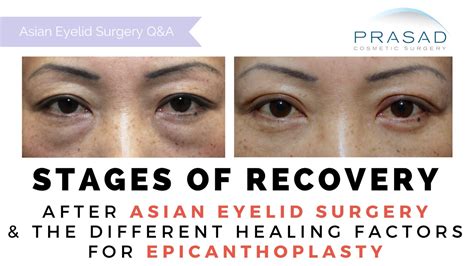 37 Blepharoplasty Before And After Recovery