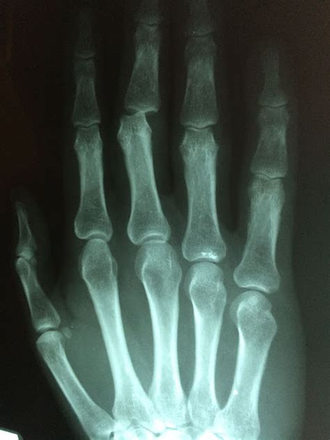 Finger Fracture Treatment Finger Bone Fracture Surgery