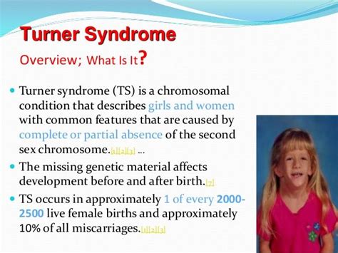 Pin By Nonas Arc On Turner Syndrome Turner Syndrome Psychology Facts