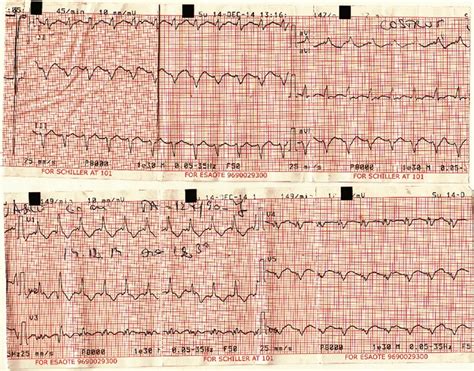 Twelve Lead Ecg During An Episode Of Palpitations The Image Shows A