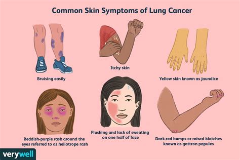 Lung Cancer Symptoms On The Skin To Watch For