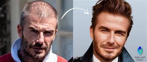 David Beckham Hair Transplant Pure Line Clinic