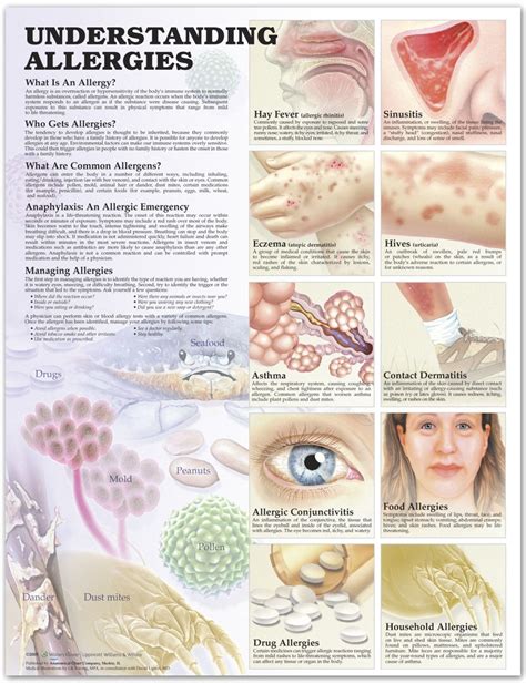 Understanding Allergies Poster Allergy Anatomical Chart Company