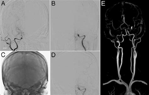 A The Right Carotid Angiogram Showed Occlusion Of The Terminal
