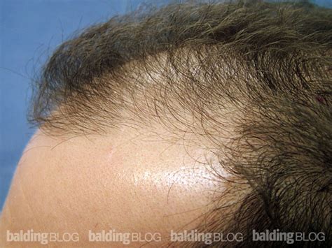 Are Minoxidil and Propecia Worth Using? (with Photos ...