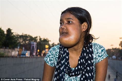 Indian Girls Cheeks Swell Due To Mysterious Condition Daily Mail Online