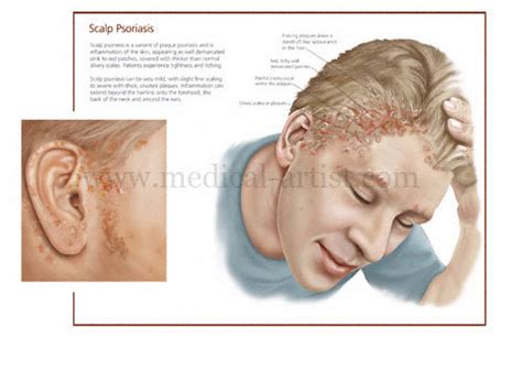Psoriasis Medical Illustrations Histopathology Of Psoriasis Scalp